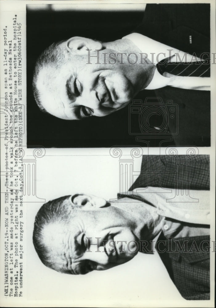 1965 Wire Photo Johnson&#39;s photo before&amp;after he went to major surgery in BNH - Historic Images