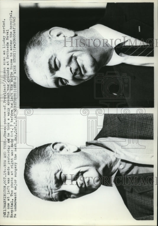 1965 Wire Photo Johnson's photo before&after he went to major surgery in BNH - Historic Images
