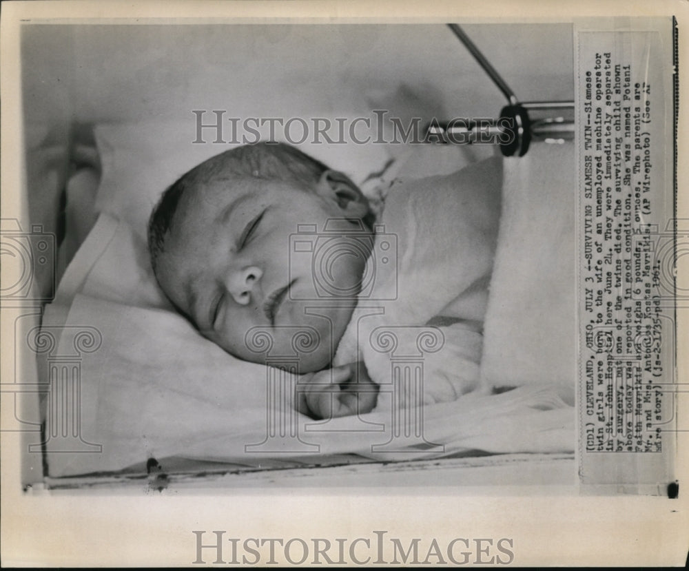 1961 Press Photo Surviving Siamese Twin Girl born In Cleveland, Ohio.- Historic Images