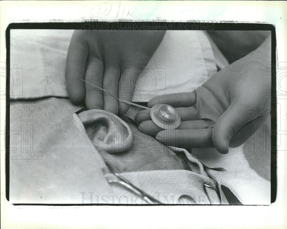 1986 Press Photo The cochlear ear implant - Historic Images