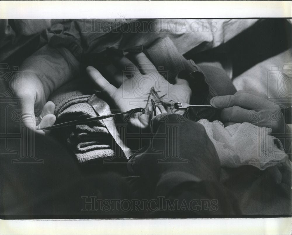 1979 Press Photo Hand Surgery Operation Surgeon Doctor - Historic Images