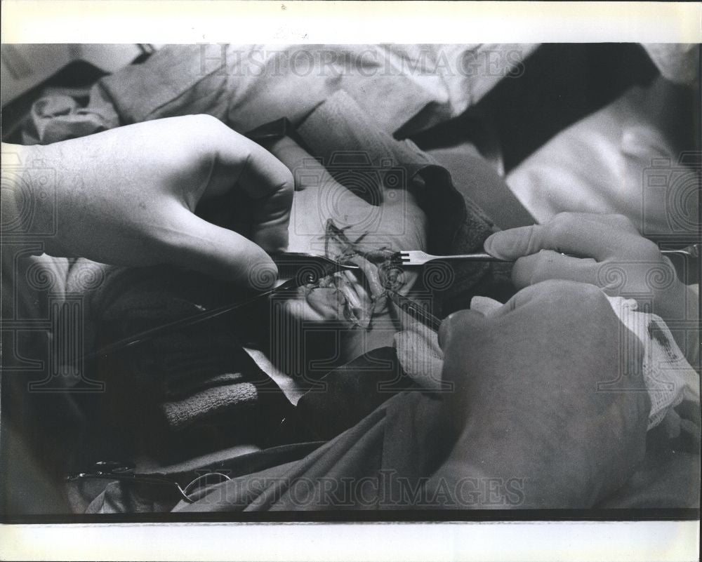 1970 Press Photo surgery, hand, stitches, scalpel - Historic Images
