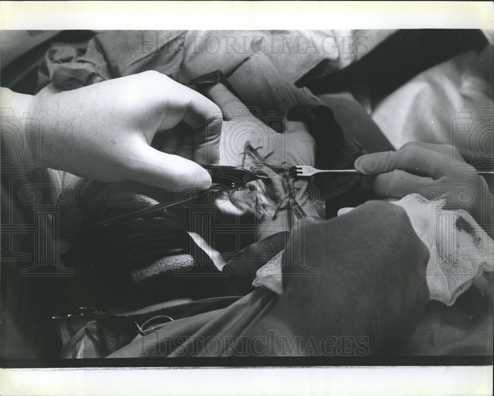 Press Photo Surgery Hand Doctors Suregon Hospital - Historic Images