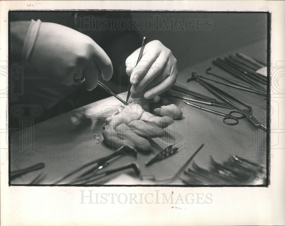 1988 Press Photo hand reattachment - Historic Images