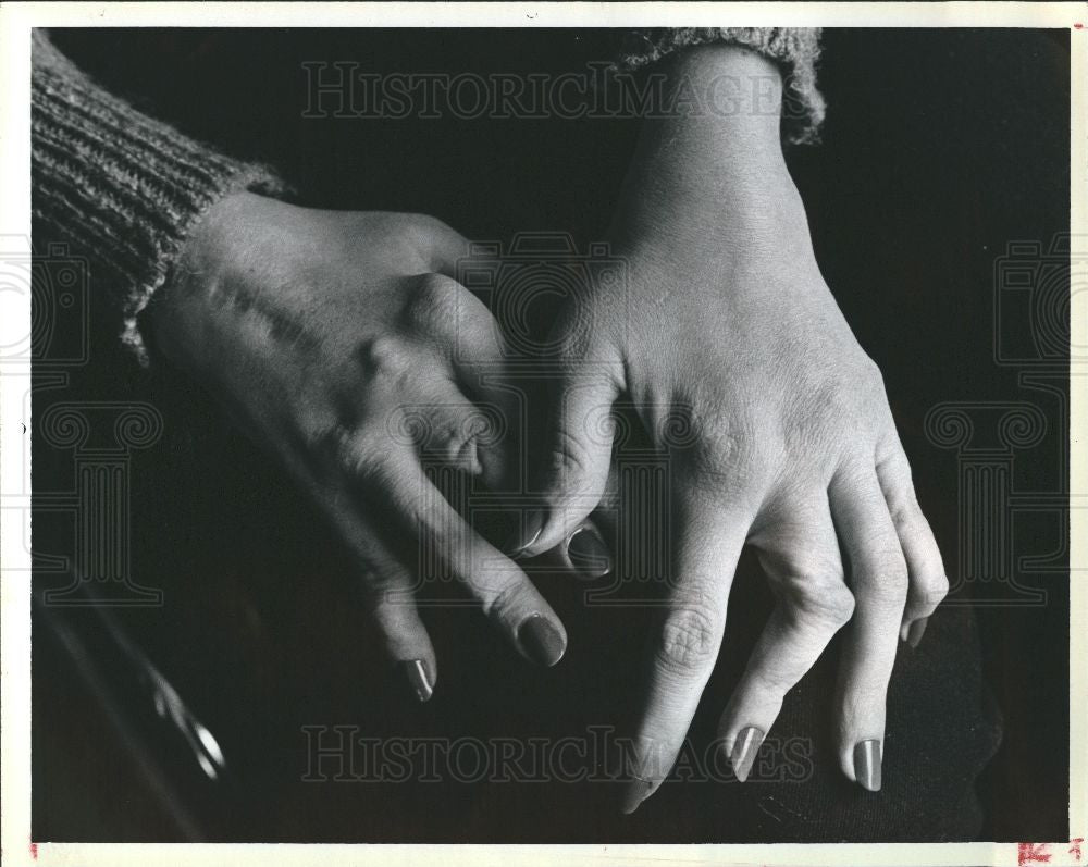 1984 Press Photo Karen Moore Rheumatoid Arthritis Hand - Historic Images