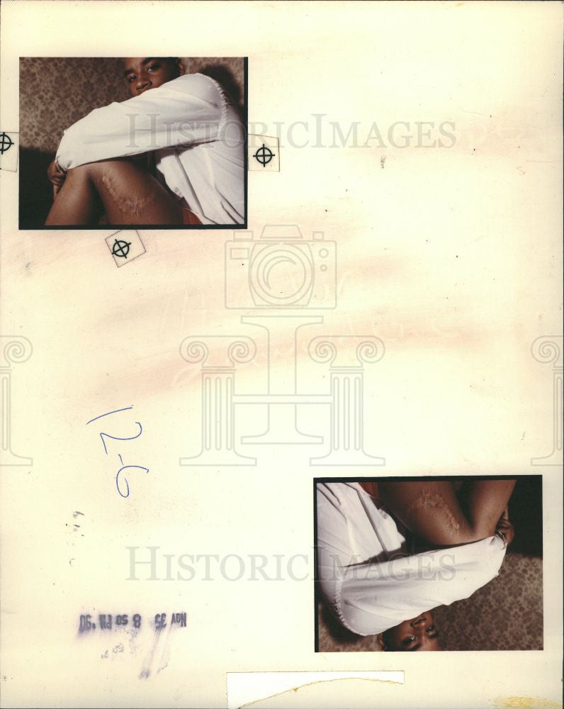 1990 Press Photo cephas byrd victim racial hate crime - Historic Images
