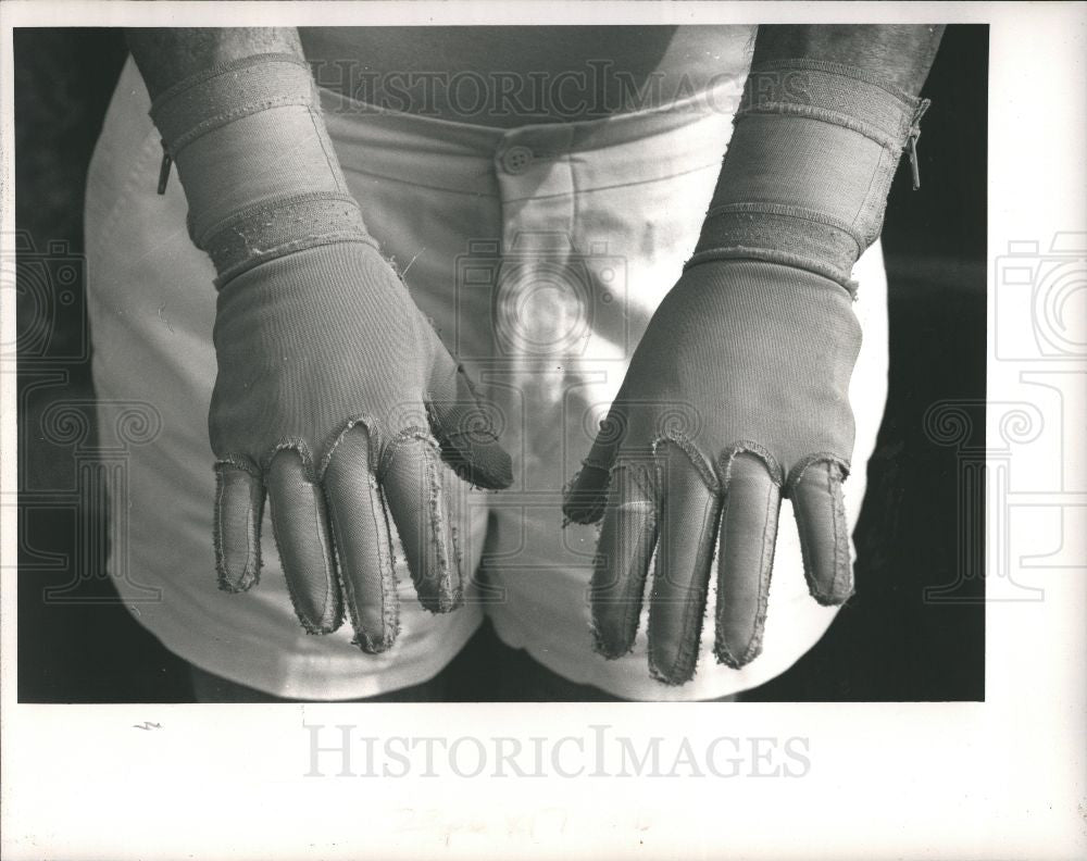 1988 Press Photo Favio gloves skin grafts - Historic Images