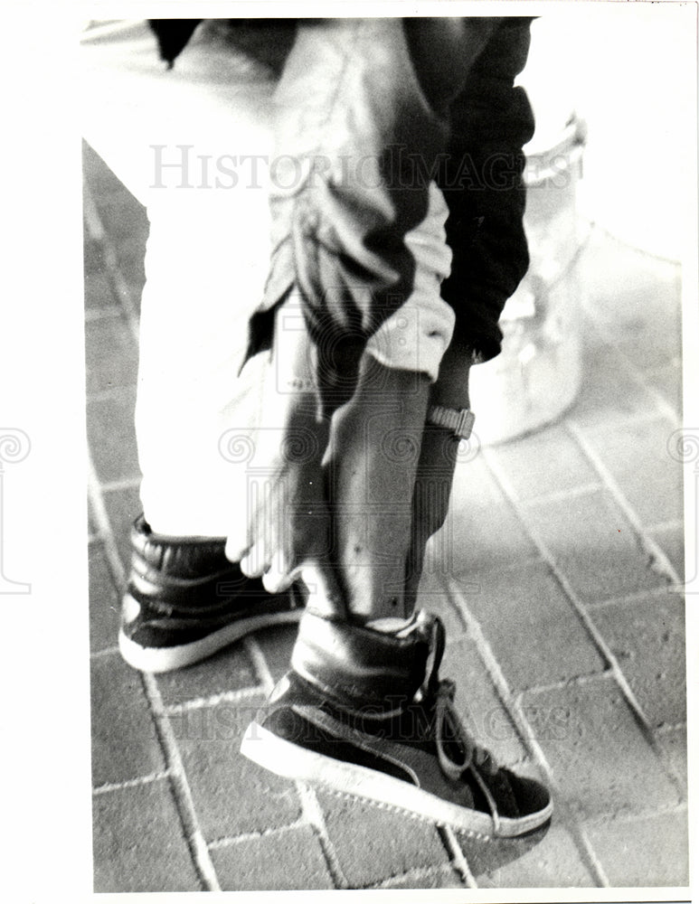 1985 Antel pellet wounds leg 1985-Historic Images