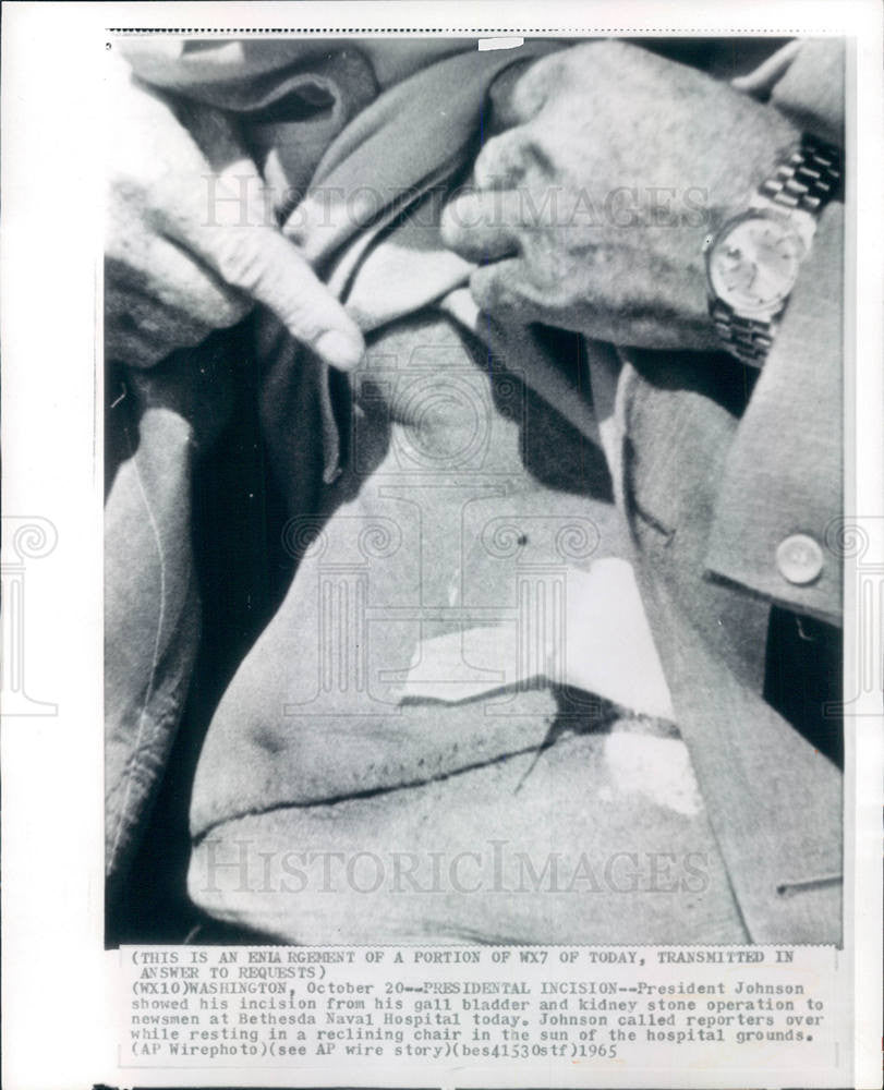 1965 Press Photo Lyndon Johnson Bethesda Naval Incision - Historic Images