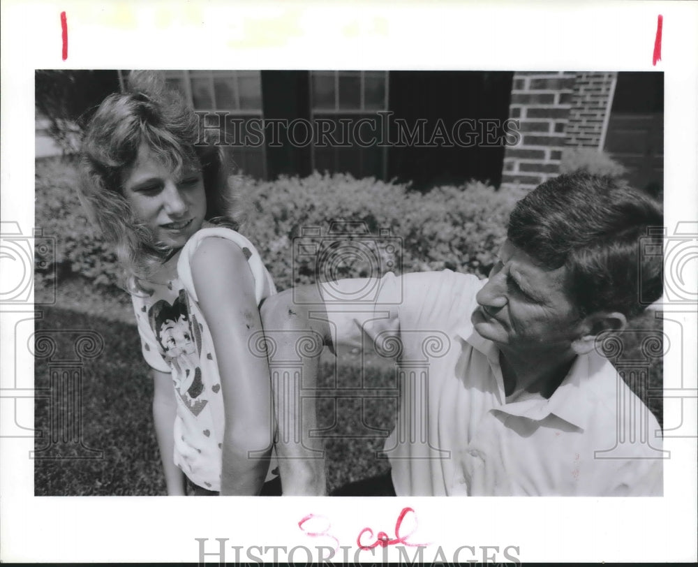 1987 Father & daughter display dog bites from pit bull attack,Spring - Historic Images