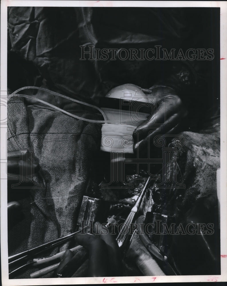 1988 Artificial Heart Pump - Historic Images