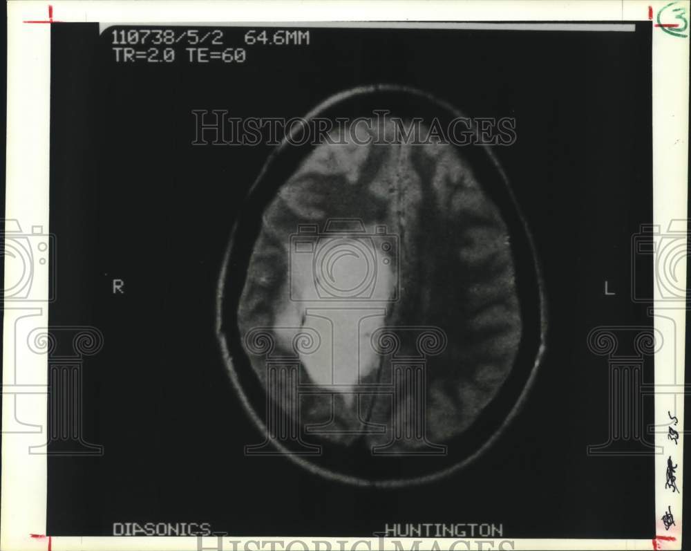 1987 Press Photo Brain Tumor image on an magnetic resonance image - Historic Images