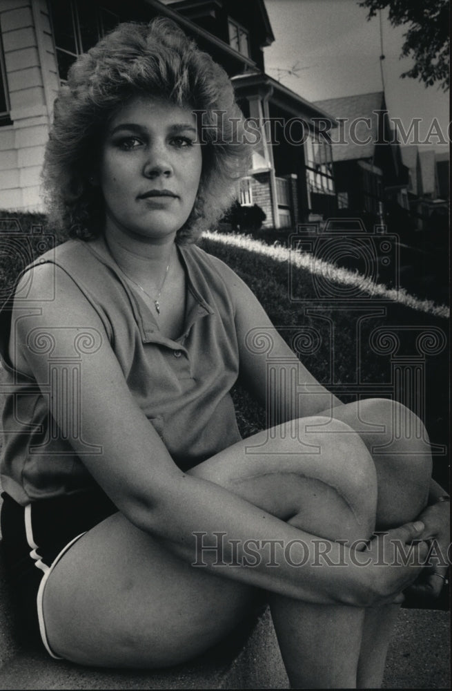 1986 Press Photo Constance Johnson, scar on left leg- from gymnastic accident-Historic Images