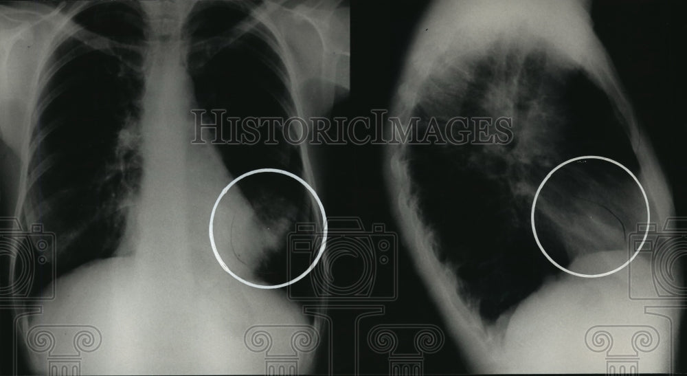 1989 Press Photo Pneumonia As A Hazy Spot as Seen in These X-Rays - Historic Images