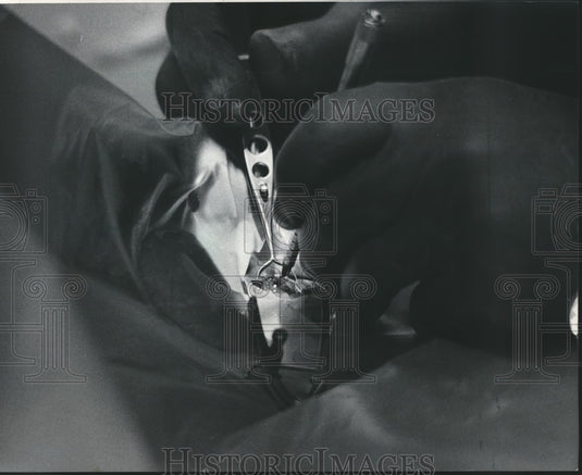 1985 Press Photo Thomas Alpren prepares an eye patient at St. Francis Hospital - Historic Images
