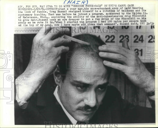 1984 Press Photo Greg Eusani uses an eye dropper to put Minoxidil on scalp. - Historic Images