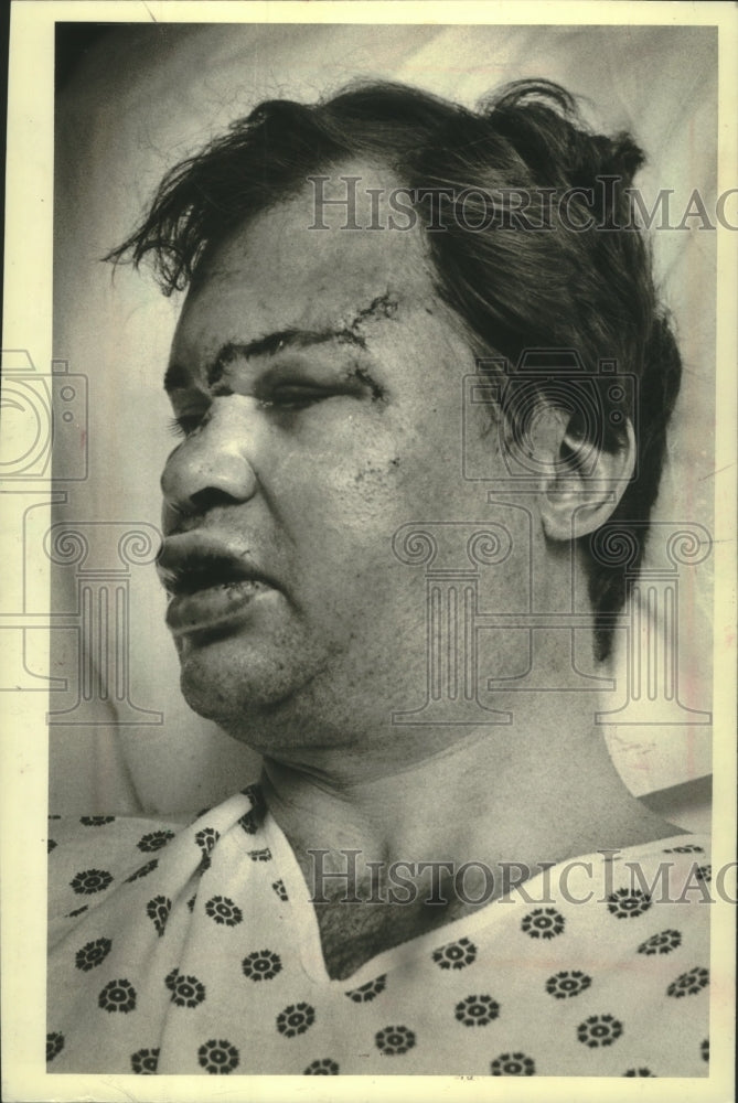 1981, Unidentified man suffers facial injuries allegedly by police - Historic Images