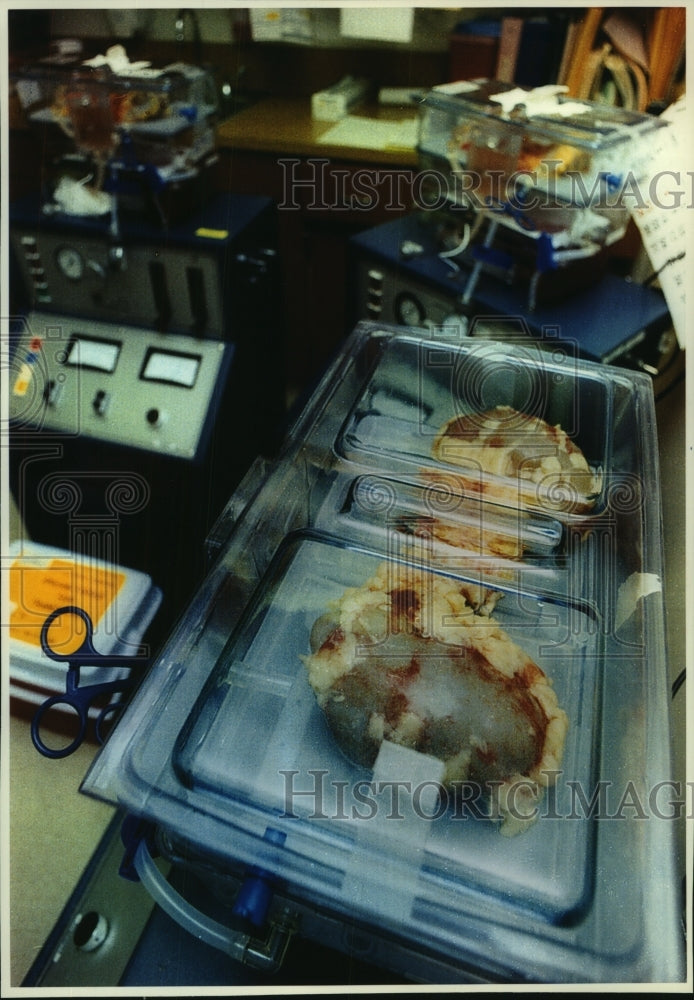 1993 Kidneys ready for transplant, Froedtert Memorial Lutheran Hosp - Historic Images