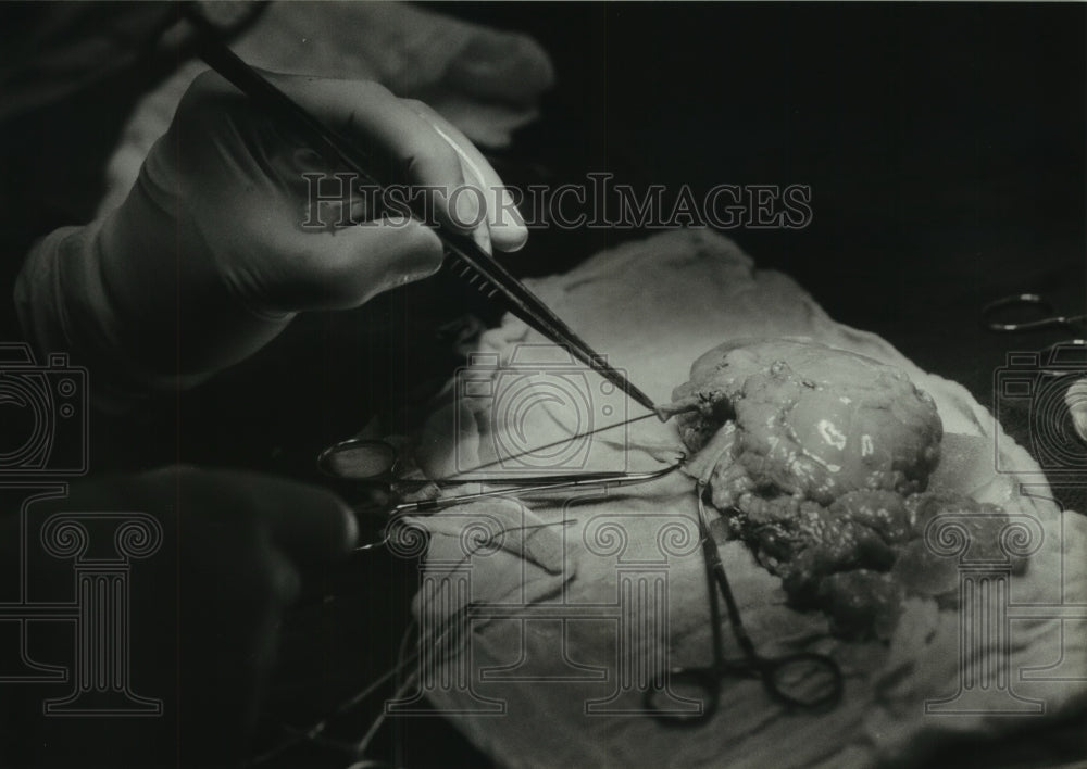 1993 Press Photo Kidney being prepared for transplant in Russ Ensweller - Historic Images