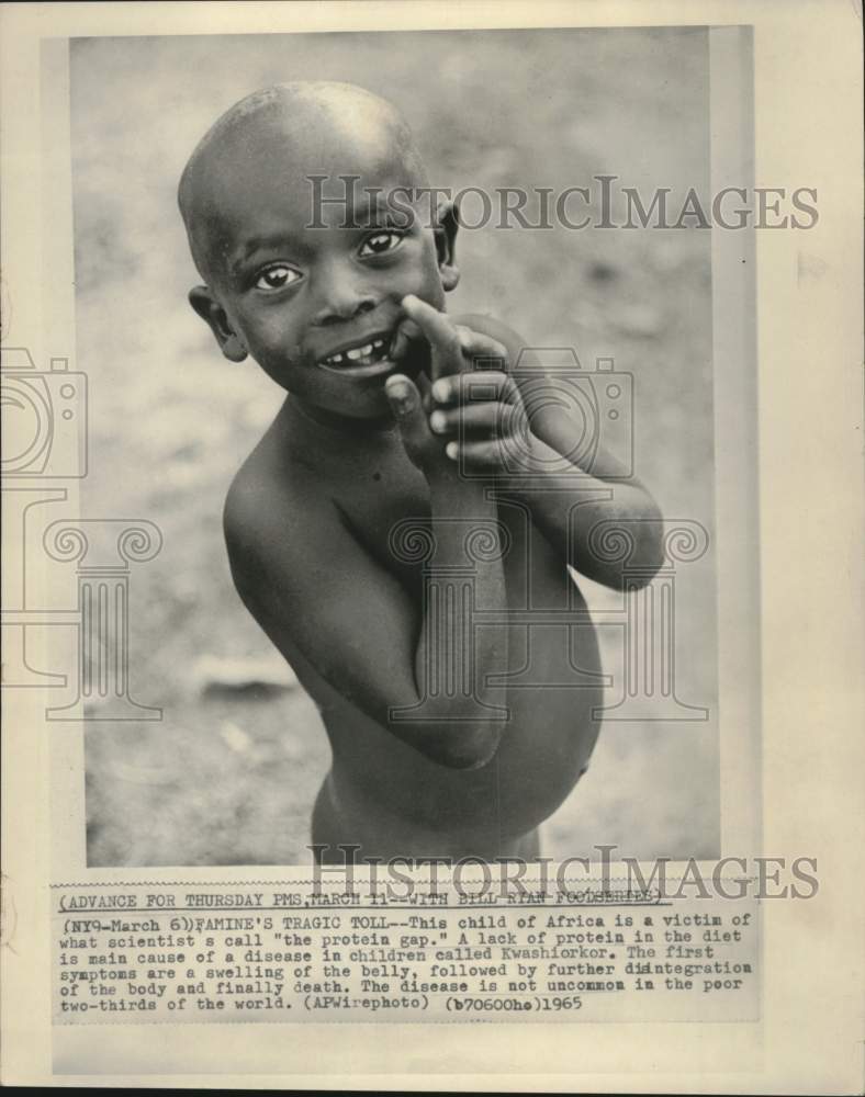 1965, African Child with Kwashiorkor - mjc40653 - Historic Images