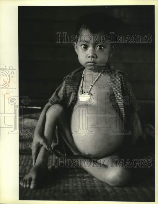 1979 Press Photo Laos refugee suffers from parasites & malnutrition in Thailand - Historic Images