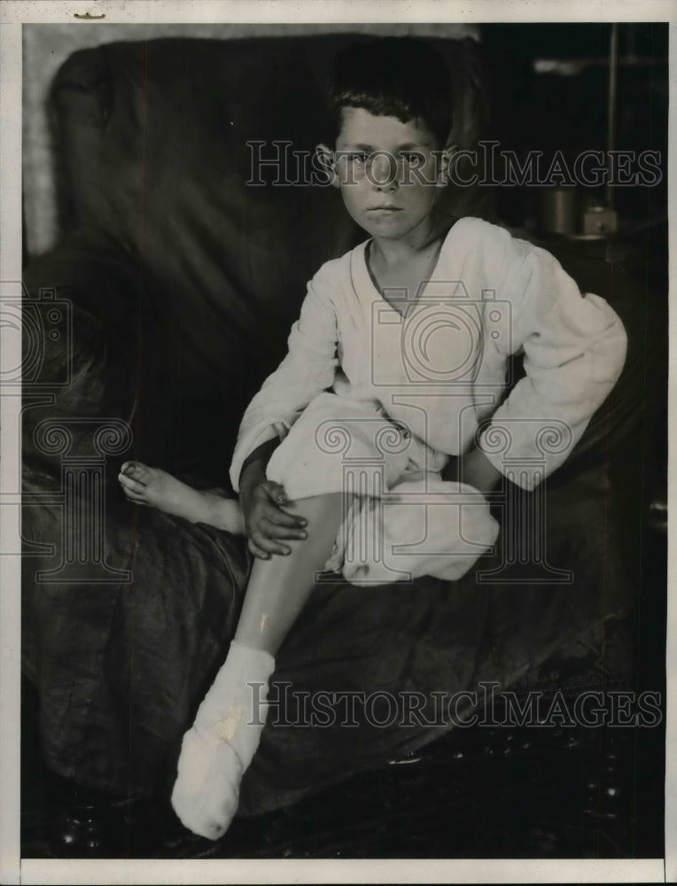 1933 Press Photo Alfred Maskell files lawsuits after severe burns to his legs - Historic Images