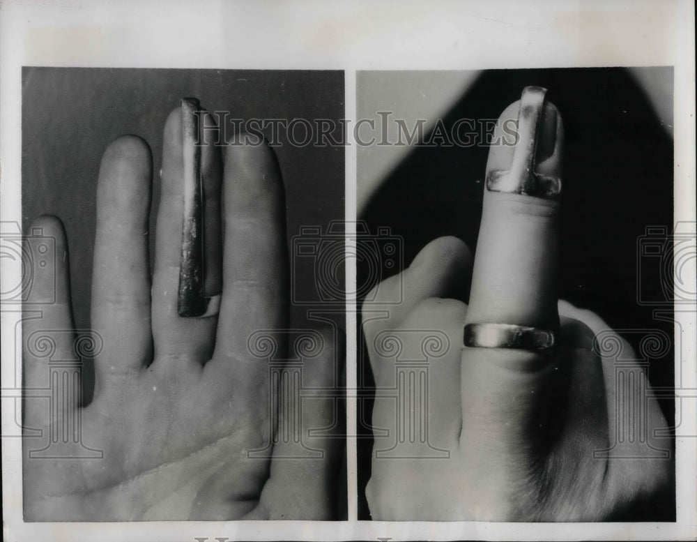 1955 Lightweight metal splint developed in Sweden for injured bones - Historic Images