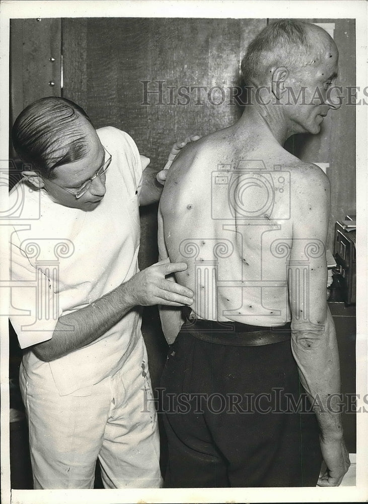 1940 Dr. Rich Johnston examining Elmer Bennis who suffered more than - Historic Images