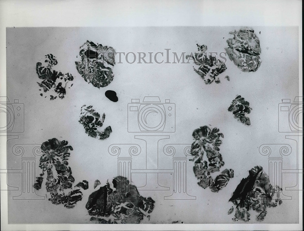 1952 Press Photo Cancer cell from a rectal lining - nea79870 - Historic Images