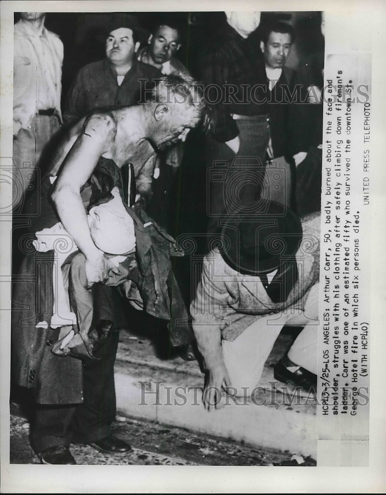 1952 Press Photo Atrhur Carr suffering from burns during fire - Historic Images