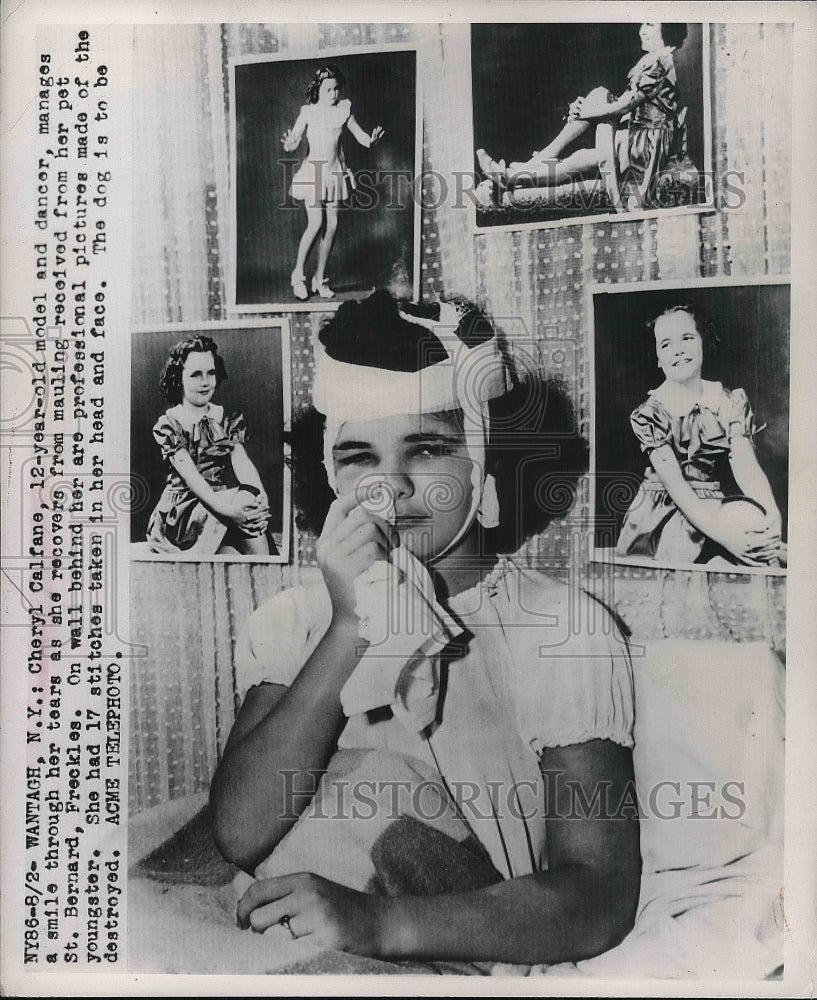 1949 Press Photo Cheryl Calfane, 12 year old model &amp; dancer after mauling by dog - Historic Images