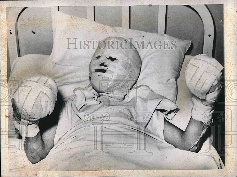 1947 Michael Zabik Jr In Hospital After Suffering 2nd Degree Burns-Historic Images