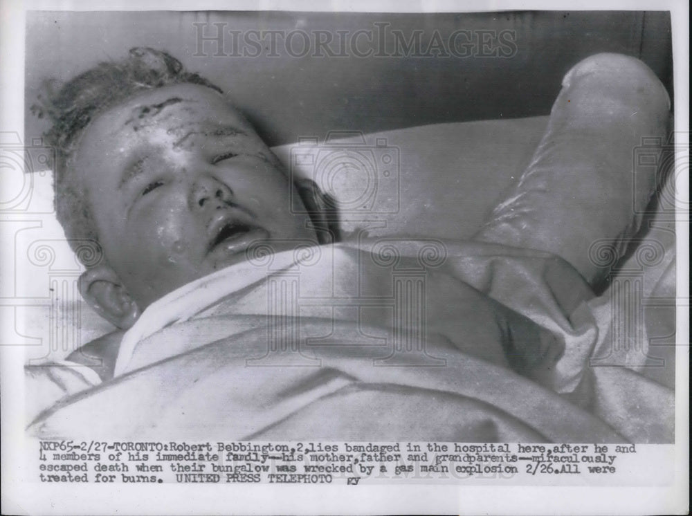 1956 Two year old Robert Bobbington in hospital after explosion - Historic Images