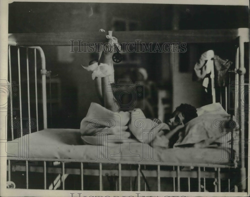 1931 Press Photo Child Recovering From Being Hit by Car Having Both Legs Broken - Historic Images