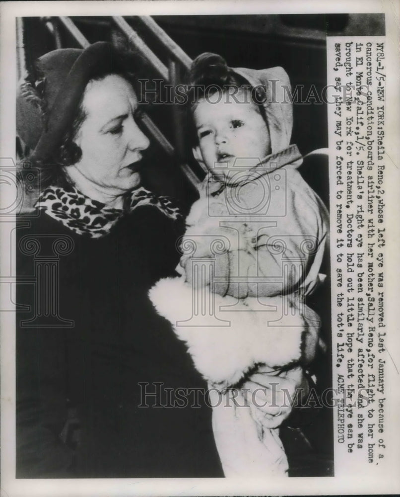 1951 Press Photo Shelia Reno,2, whose left eye was removed. - nec28108 - Historic Images