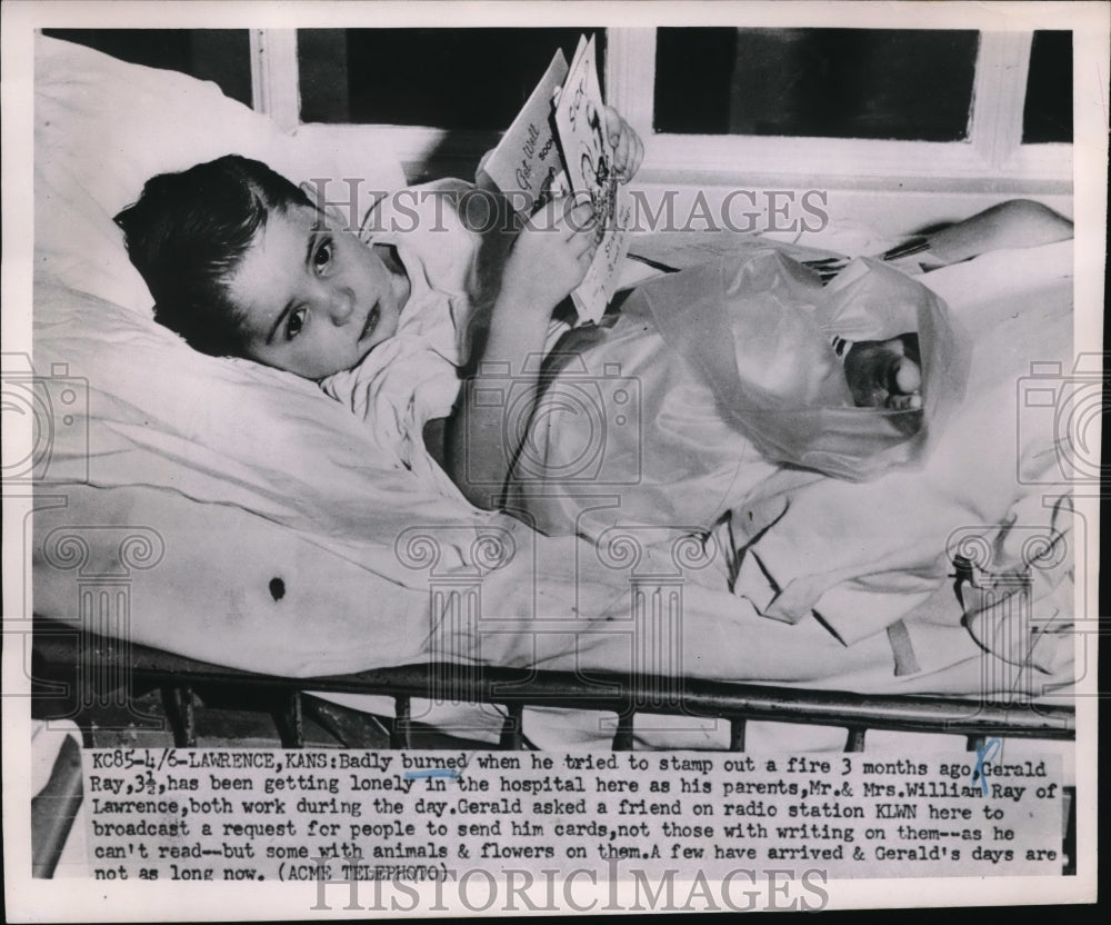 1951 Press Photo Lawrence, Kans. Gerald Ray, age 3 burned in a fire - Historic Images