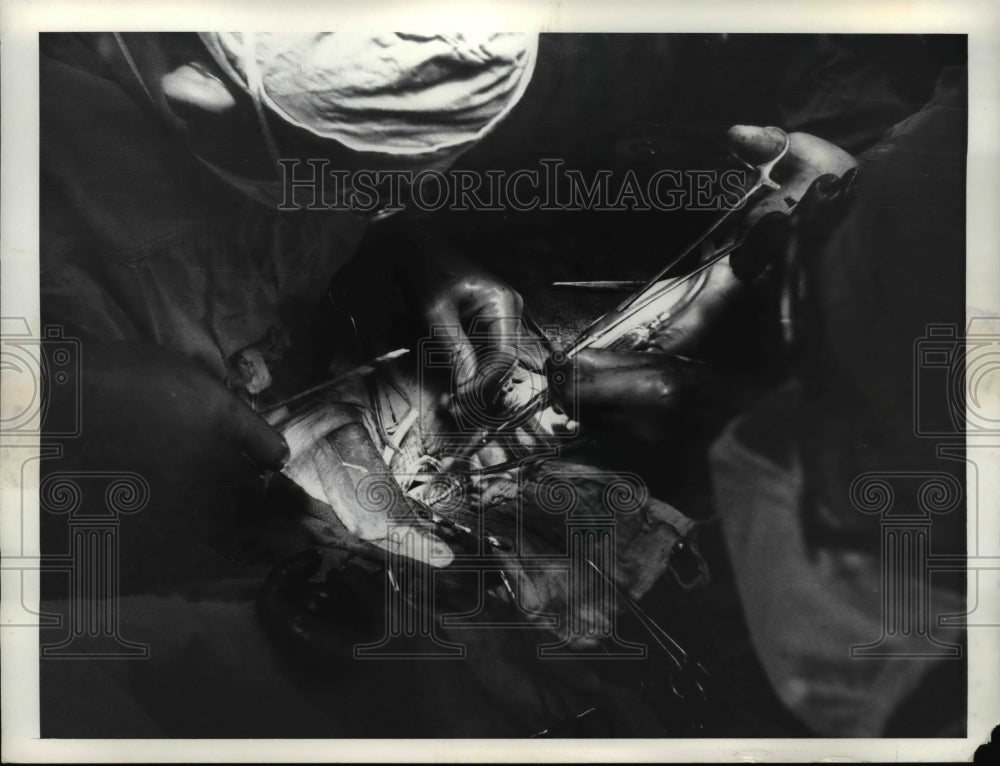 Press Photo Surgeons in an operating room with a patient - Historic Images