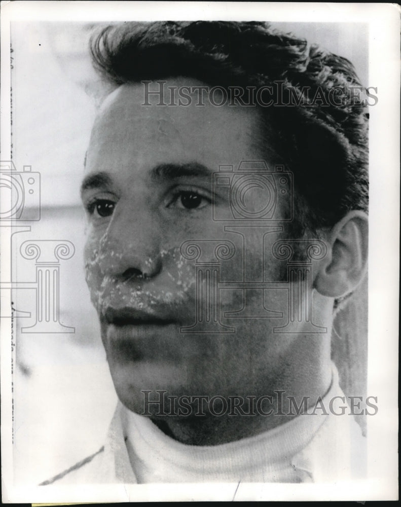 1969 Press Photo Mario Andretti, Face Burned in Indianapolis 500 Speedway Wreck - Historic Images