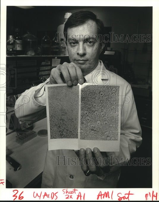 1988 Press Photo Dr. William Gallaher, AIDS researcher shows infected cells. - Historic Images