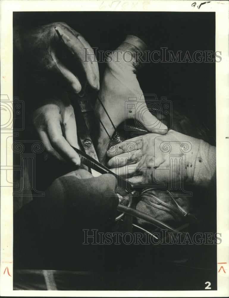 1979 Press Photo Dr. Christiaan Bernard Holds Woman's Heart in his Hand - Historic Images