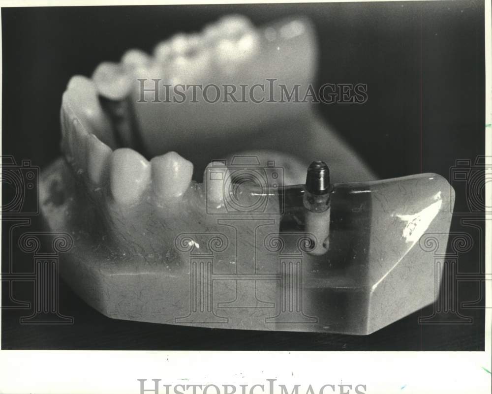 1988 Press Photo Sample tooth implants by Dr. Jack Kent - Historic Images