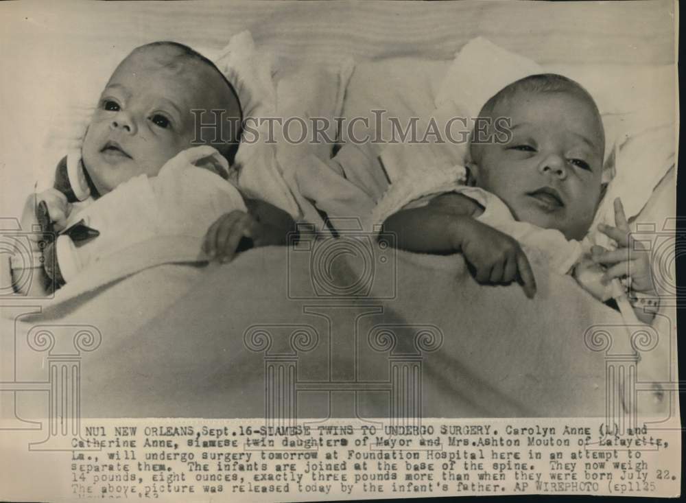 1953 Press Photo Mouton Siamese twins to undergo surgery at Foundation Hospital- Historic Images