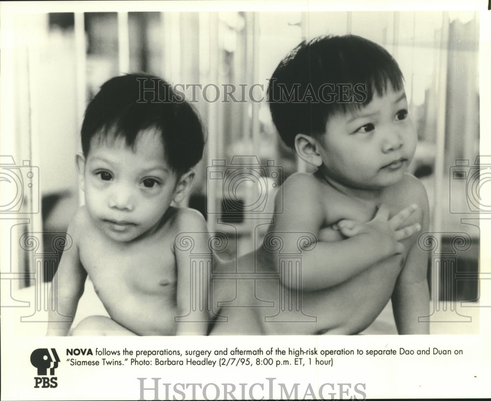 1995 Press Photo "Siamese Twins" Dao and Duan prior to separation operation - Historic Images